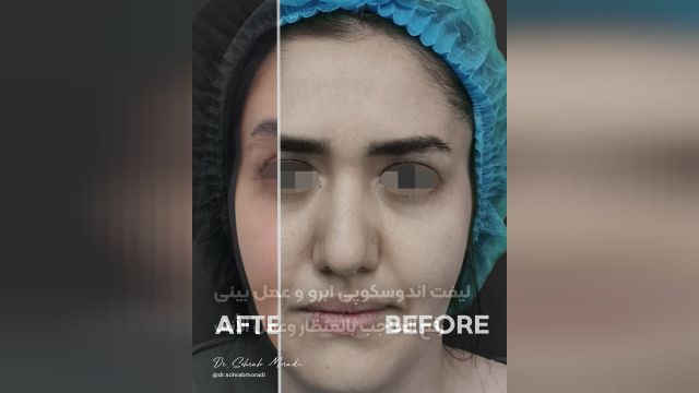 رفع الحاجب بالمنظار و عملية تجميل الأنف