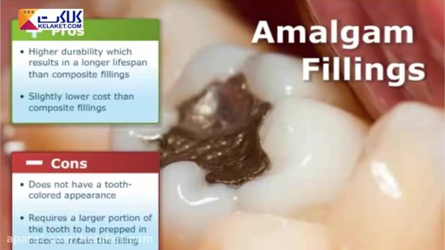 اقداماتی که بر روی دندان خراب در این ویدیوی جالب به طور کامل مشاهده می کنید