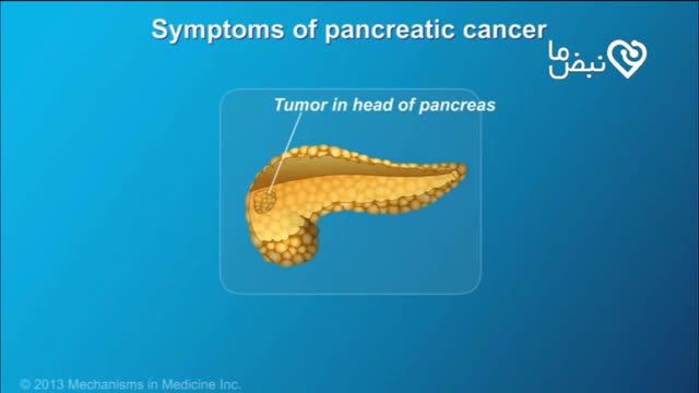 ‫همه چیز درباره سرطان پانکراس‬‎