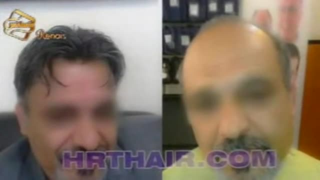 فیلم ترمیم مو به روش HRT  مرکز تخصصی مو رنسانس