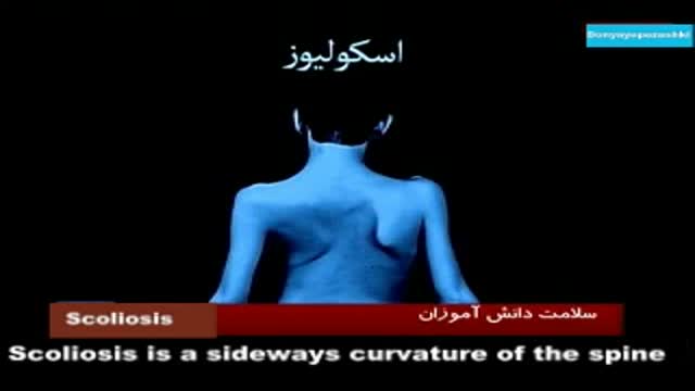 Scoliosis ; sideways curvature of the spine .اسکولیوزیس
