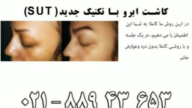 کاشت ابرو طبیعی با روش SUT مرکز کاشت مو