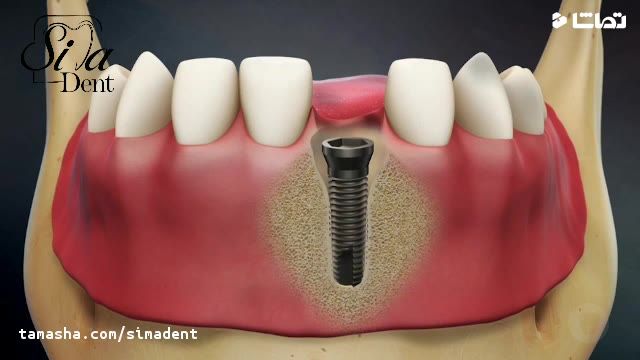 بهترین زمان برای جایگزینی دندان از دست رفته-متخصص پروتزهای دندانی