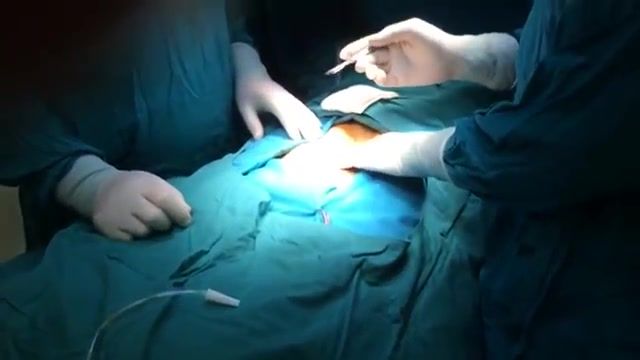 ‫فیلم جراحی پروستات به روش باز توسط دکتر کرمی‬‎