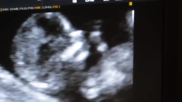 Nuchal translucency (NT) scan - Week 12 of pregnancy - سونوگرافی سه ماهه اول حاملگی