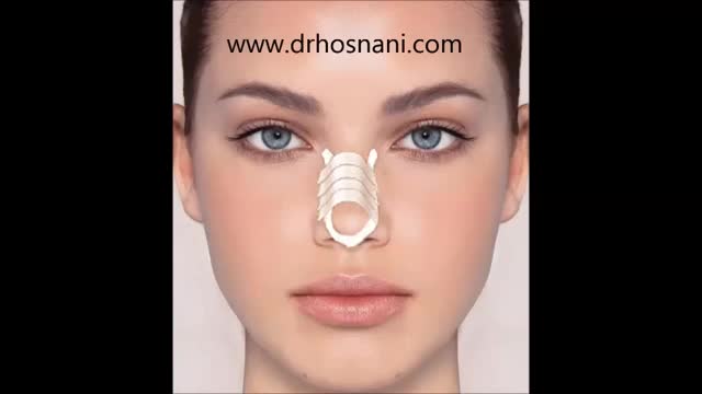 ‫دکتر حسنانی: روش صحیح چسب زدن بینی بعد از عمل بینی‬‎