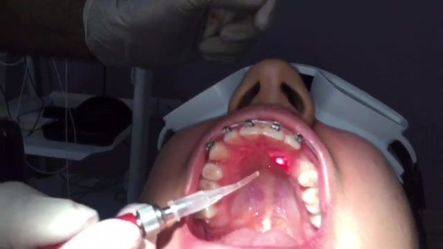 جراحی دندان نهفته با لیزر