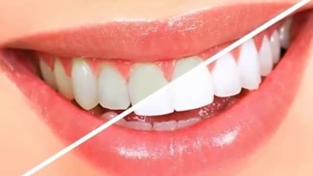 ‫6 راه سفید کردن دندان ها در خانه‬‎