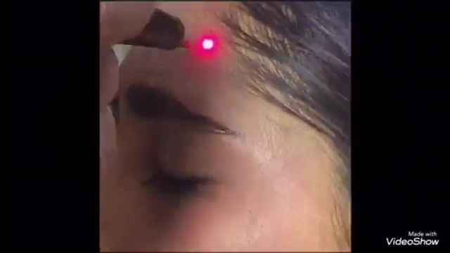 laser for face لیزر جهت روشنی سفتی و شفافیت پوست صورت