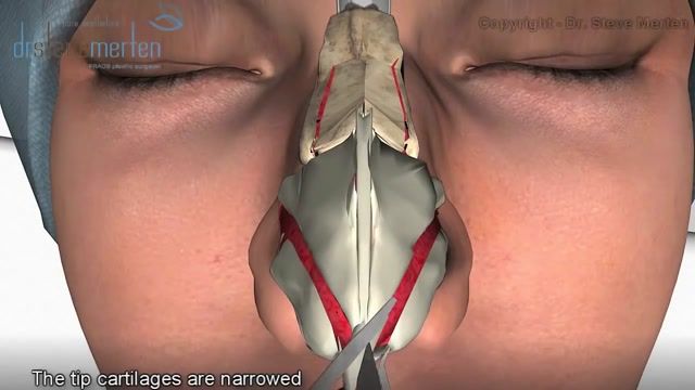 فیلم جراحی بینی یا رینوپلاستی - سایت nosesurgery.center