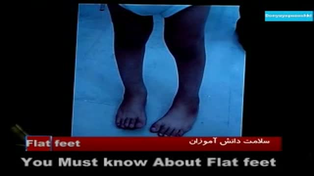 Flat feet in CHILDREN.صافی کف پا ها در بچه ها