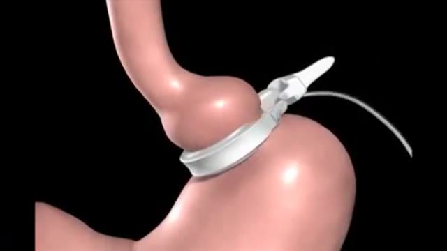 Gastric Banding عمل جراحی چاقی حلقه ی قابل تنظیم دور معده