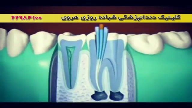 عصب کشی و پر کردن کامپوزیتی دندان 