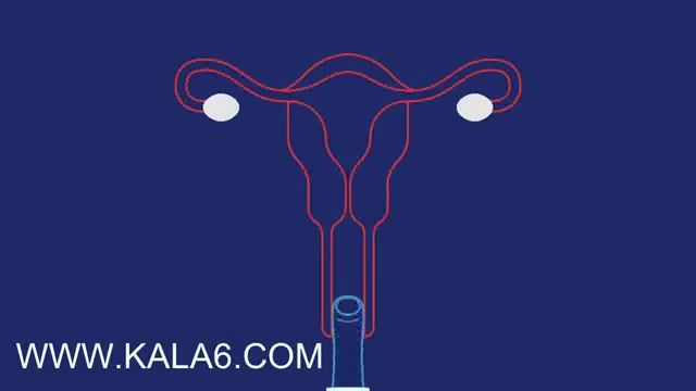 ‫کاندوم زنانه چیست و چگونه کار می کند (www kala6 com)‬‎