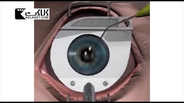 مشاهده فیلم عمل جراجی چشم به نام لیزیک 