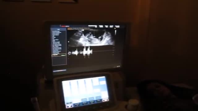 ‫سونوگرافی هفته 12 حاملگی - 910918 - pregnancy ultrasound Week 12‬‎