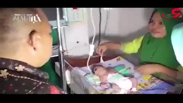 وحشت پزشکان از تولد نوزاد تک چشم در اندونزی
