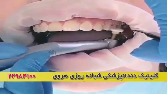 زیبایی و یکدستی دندانها بعد از ارتودنسی دندان