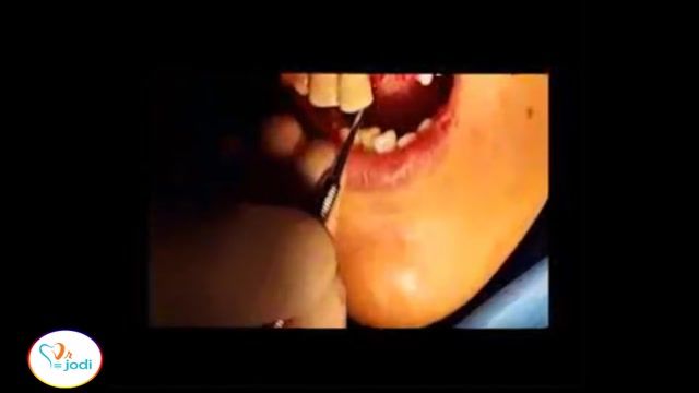 ایمپلنت دندان بیماران