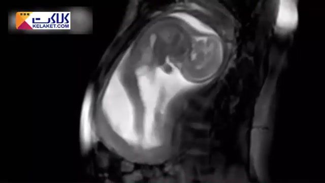 تصاویر اسکن شده از MRI یک جنین در حال حرکت در داخل رحم