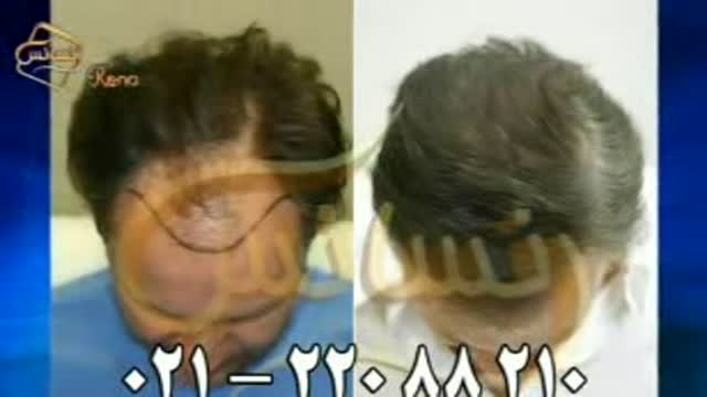 فیلم کاشت مو به روش SUT مرکز مو رنسانس