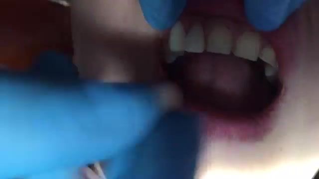 ‫فیلم لمینت دندان‬‎
