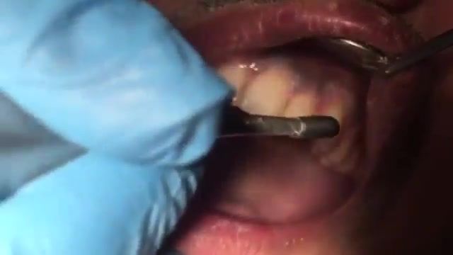 ‫جرم گیری دندان مرحله دوم‬‎
