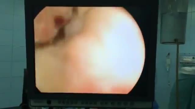 ‫فیلم عمل جراحی پروستات به روش اندوسکوپی‬‎