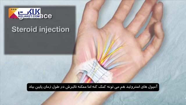 مراحل درمان سندروم تونل کارپال که عارضه ای در مچ دست میباشد چیست؟