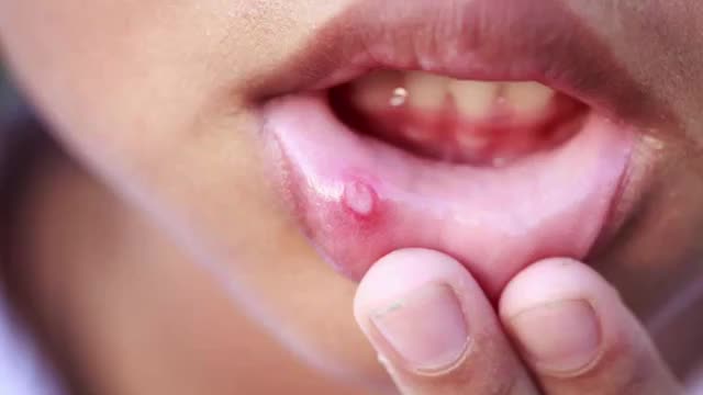 ‫علل ایجاد آفت دهانی و بهترین روش های درمان آن‬‎