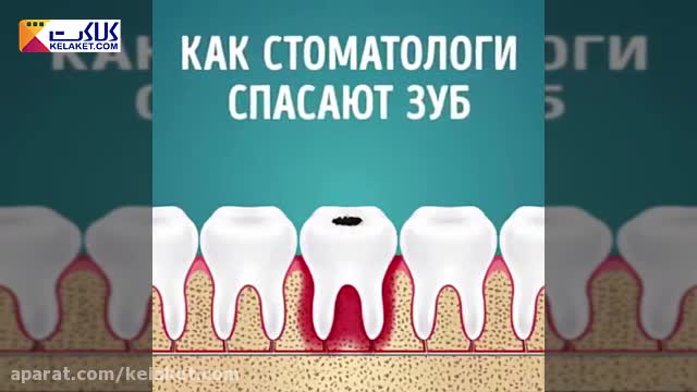 مراحل واضح عصب کشی دندان 