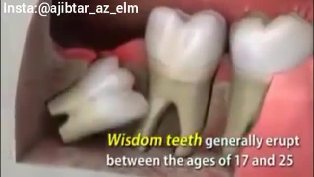 همه چیز درباره دندان عقلی که باید کشیده شود