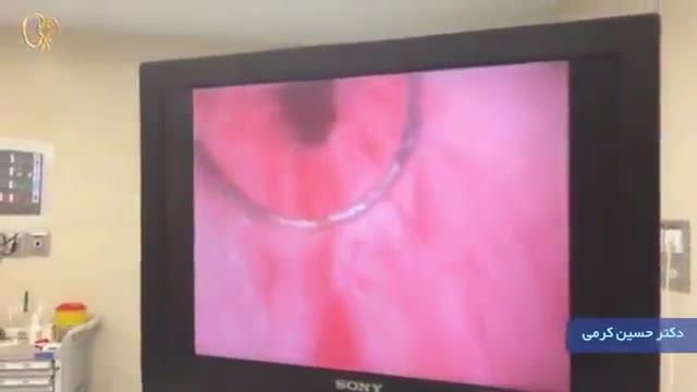 ‫فیلم TURP یا عمل پروستات بدون شکاف جراحی توسط دکتر کرمی‬‎