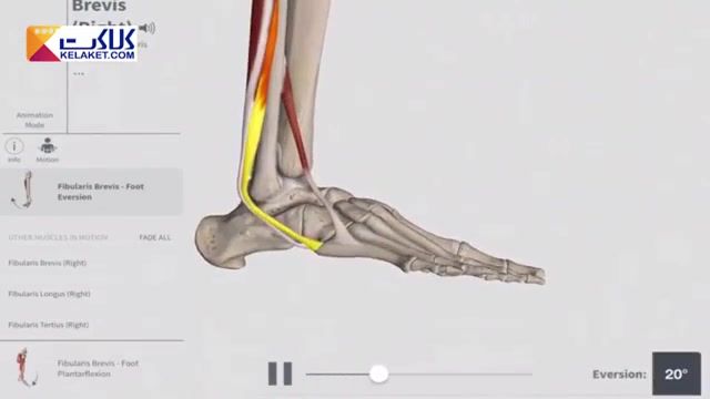شکستگی استخوان های کف پا(متاتارس)از طریق احساس درد شدید،تغییر شکل و یا تورم ..