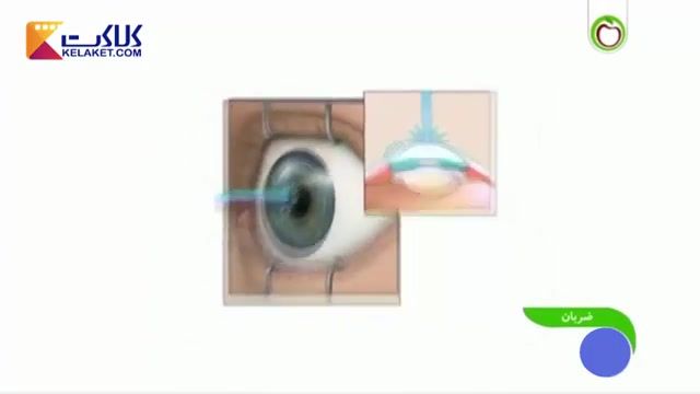 توضیحات کامل از نحوه اجرا و شرایط لازم در جراحی لیزری عیوب انکساری چشم