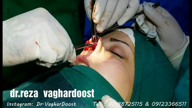 جراحی بینی توسط دکتر رضا وقردوست