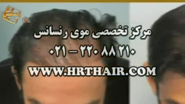 کاشت مو به روش SUT مرکز مو رنسانس