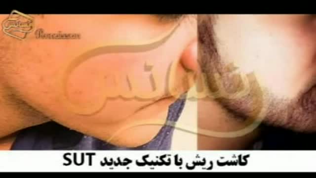 کاشت ریش و سبیل به روش SUT مرکز مو رنسانس