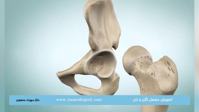 آرتروپلاستی مفصل ران چیست