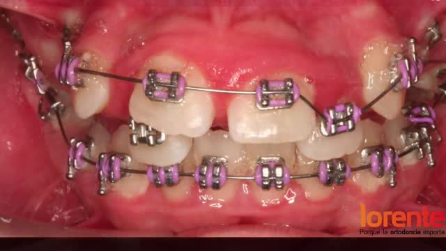 فیلم قبل و بعد ارتودنسی|کلینیک دندانپزشکی مدرن
