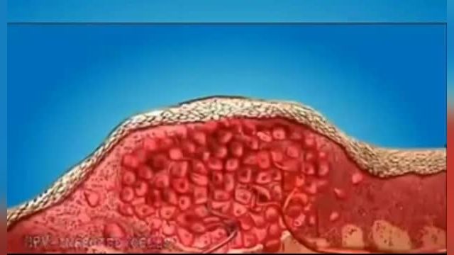 درمان زگیل تناسلی در زنان و مردان با لیزر توسط دکتر بیژن عابدیان