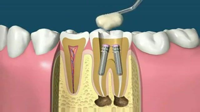 فیلم کامل عصب کشی دندان و روکش کردن دندان