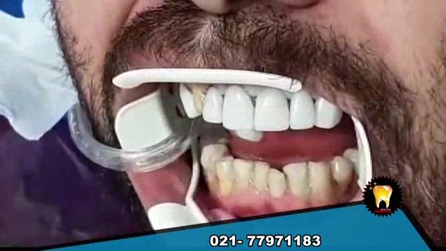 لمینت دندان چگونه انجام می شود