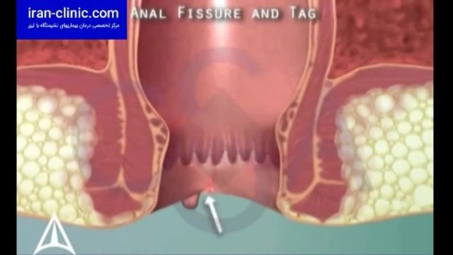 خطر بروز بواسیر یا هموریید در بین افراد شاغل - ایران کلینیک