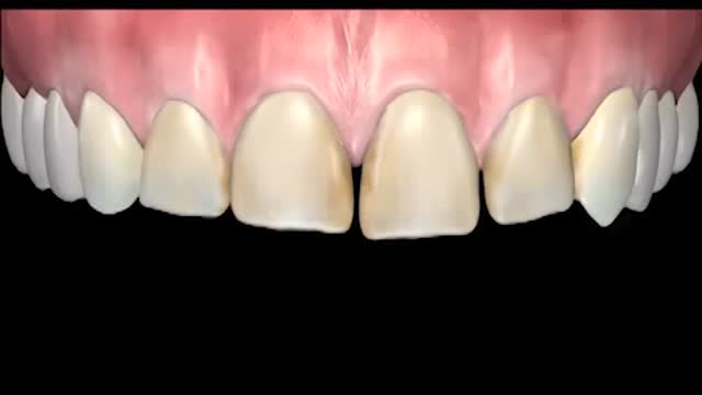 مراحل کلی لمینیت دندان در دندانپزشکی زیبایی|کلینیک دندانپزشکی مدرن