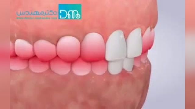 علت مهم دندان قروچه در افراد چیست؟