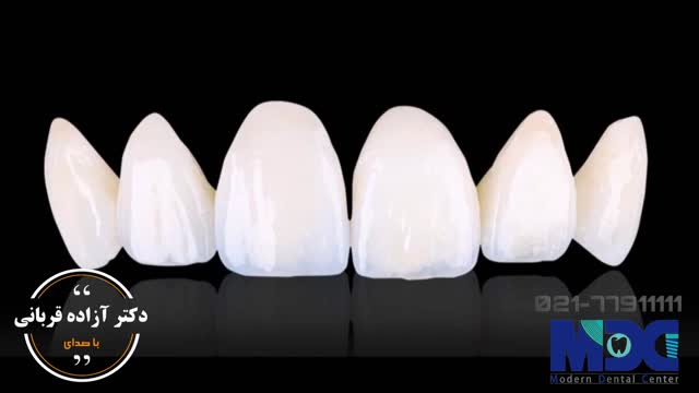 تفاوت لمینیت و کامپوزیت|کلینیک دندانپزشکی مدرن
