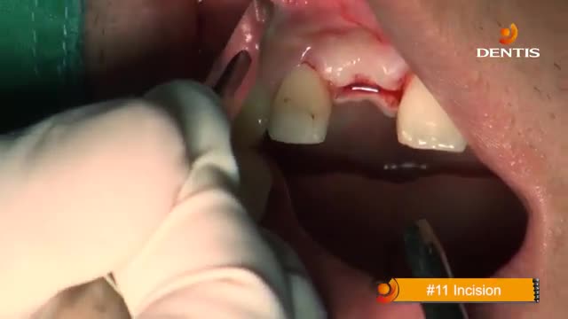 ایمپلنت - کلینیک دندانپزشکی تاج