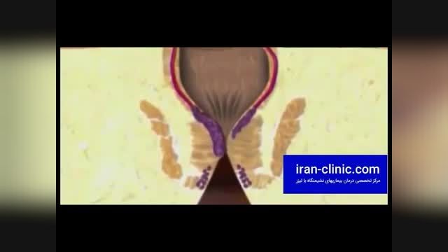 شناخت بیماری بواسیر یا همورویید و علل بروز این بیماری در ایران کلینیک