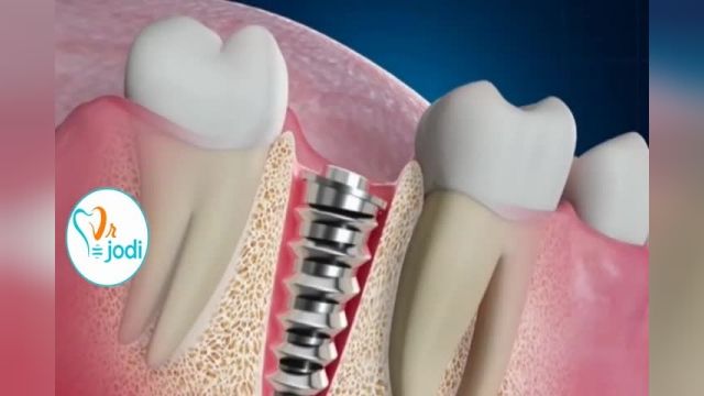 ویدیو جالب در مورد ایمپلنت دندان